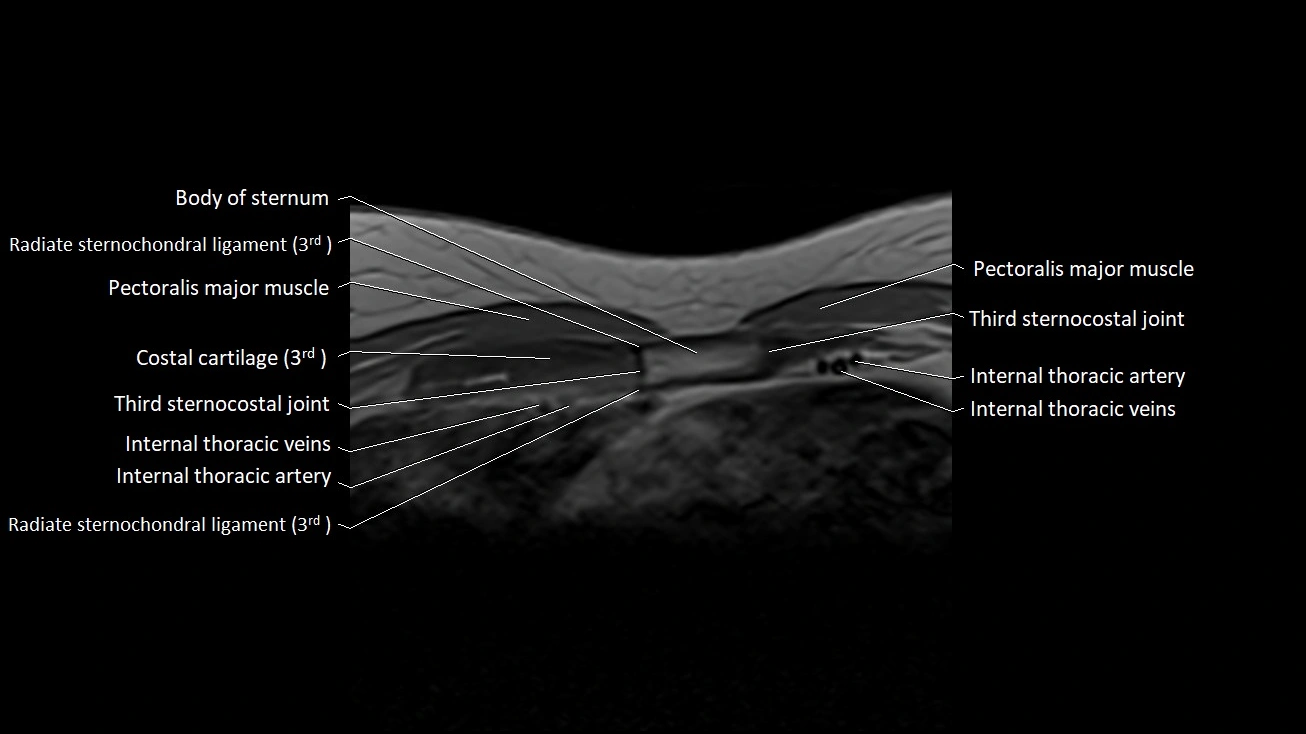 MRI sternum and sternoclavicular joint labeled axial anatomy image 19.webp